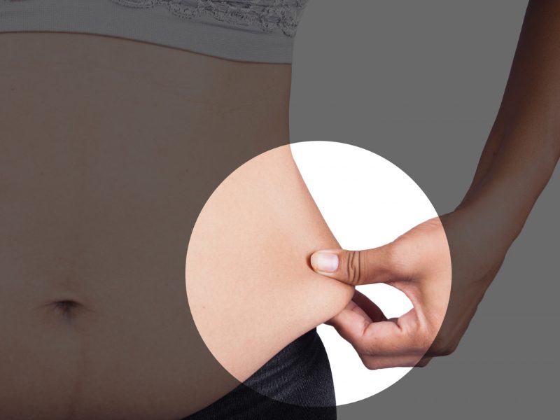 Understanding Liposuction Long Term Side Effects