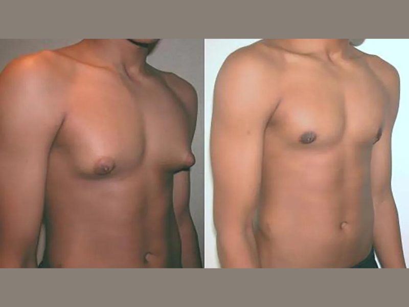 Can You Get Gynecomastia Treatment Without Surgery?