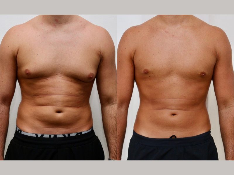 Tips On How To Make Your Gynecomastia Less Noticeable