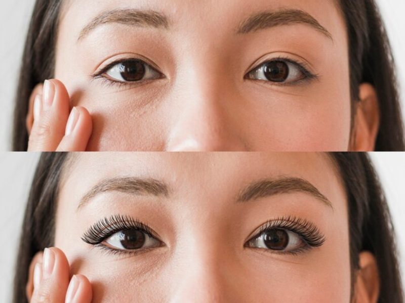 What is Non-incision Double Eyelid Surgery?
