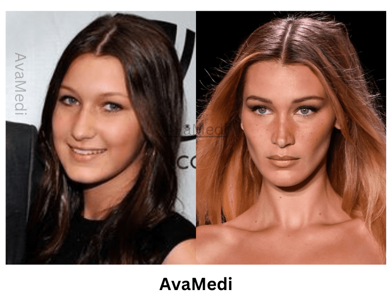 Bella Hadid before and after nose job