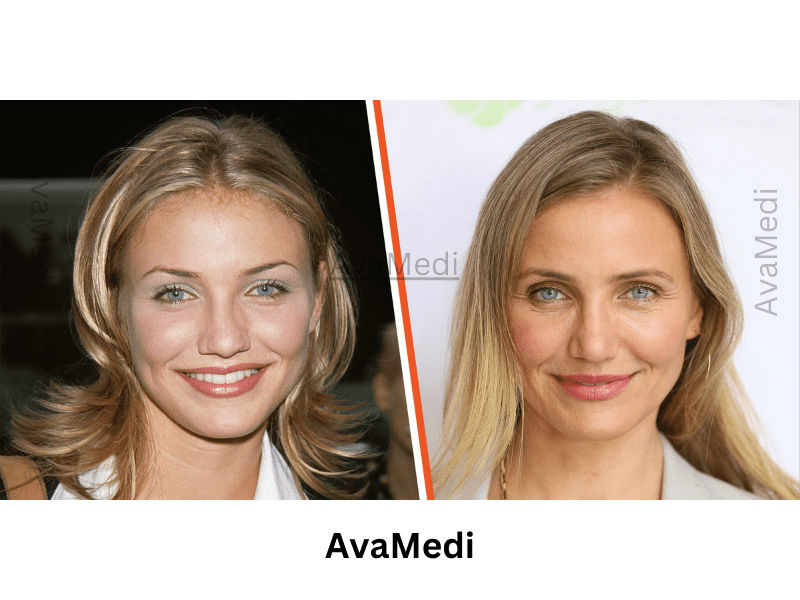 Cameron Diaz before and after nose job