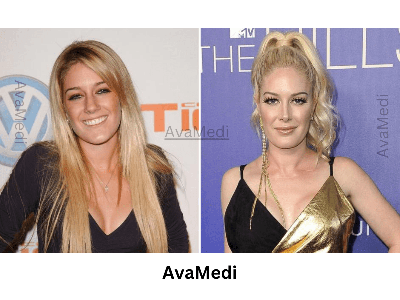 Heidi Montag before and after nose job