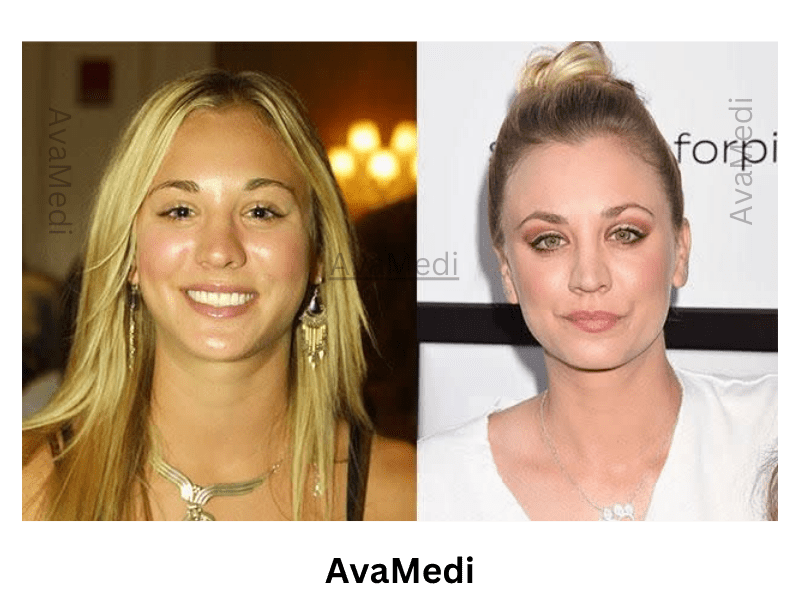 Kaley Cuoco before and after nose job