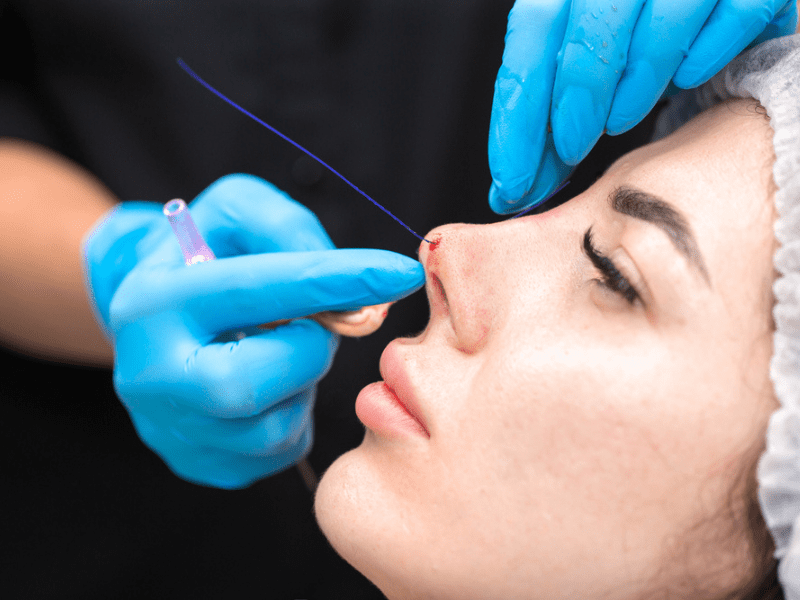 Nasal Tip Surgery for Reshaping of Nostrils
