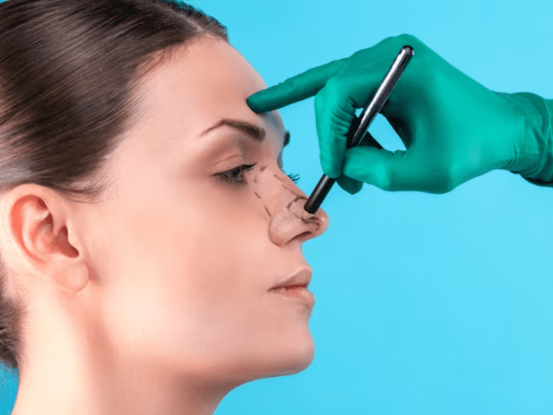 Bulbous Nose Tip Surgery Recovery; Dos & Don’ts